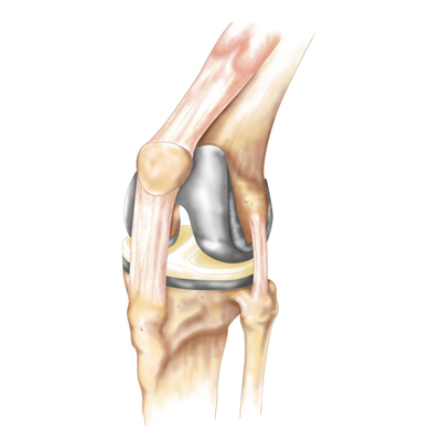 Knee joint showing total knee replacement