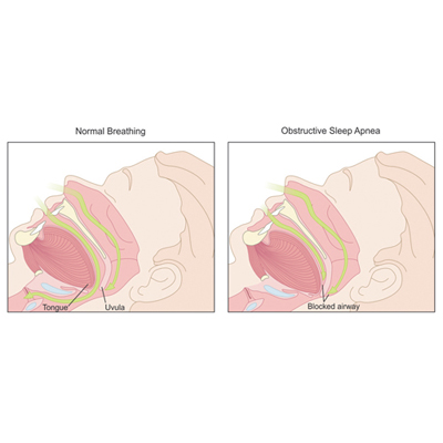 Two illustrations -first shows open airway and second illustration shows an obstructed airway.
