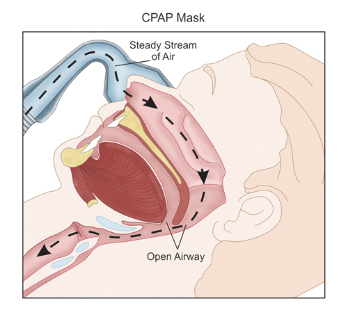CPAP