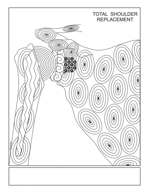 Shoulder Joint Replacement Coloring Book Page